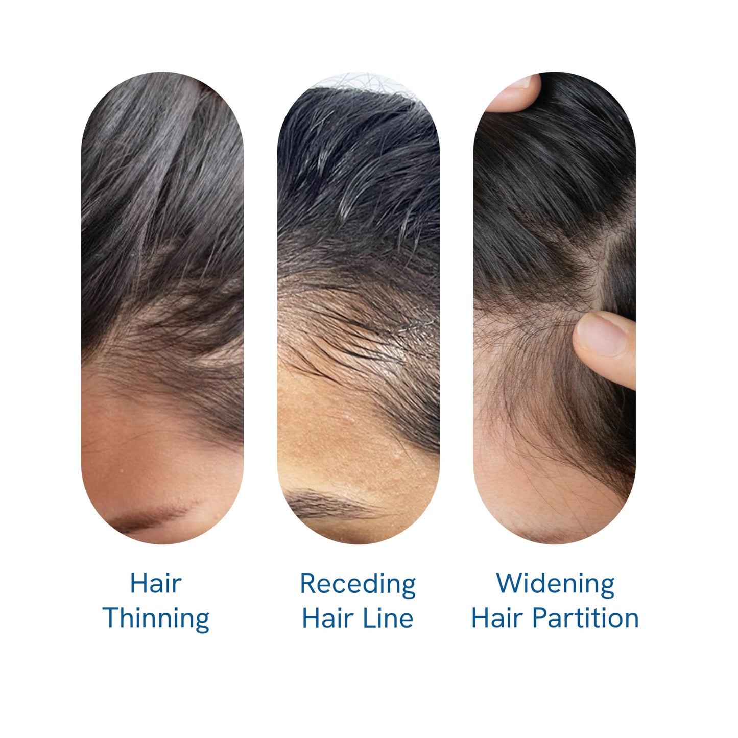 Be Bodywise Rosemary Hair Growth Serum Roll On 25 ml – 3% Rosemary, 3% Redensyl & 2% Anagain | DHT-Blocking Scalp Serum Boosts Oxygen Flow, Reduces Hair Fall | Paraben/Sulfate-Free | Women & Men