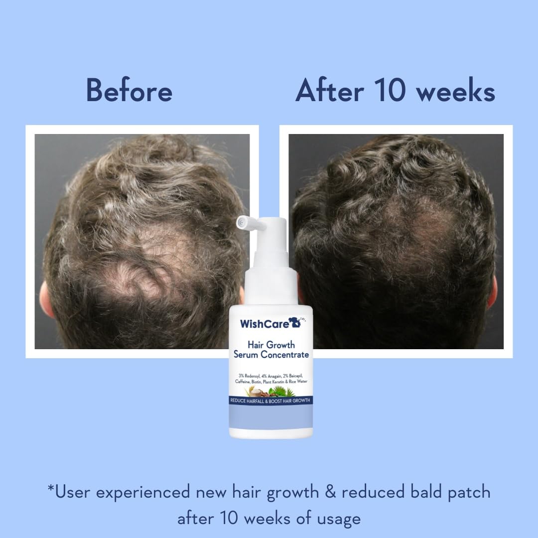 Hair Growth Serum Concentrate - Rosemary, 3% Redensyl, 4% Anagain, 2% Baicapil, Caffeine, Biotin, Plant Keratin & Rice Water
