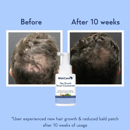 Hair Growth Serum Concentrate - Rosemary, 3% Redensyl, 4% Anagain, 2% Baicapil, Caffeine, Biotin, Plant Keratin & Rice Water