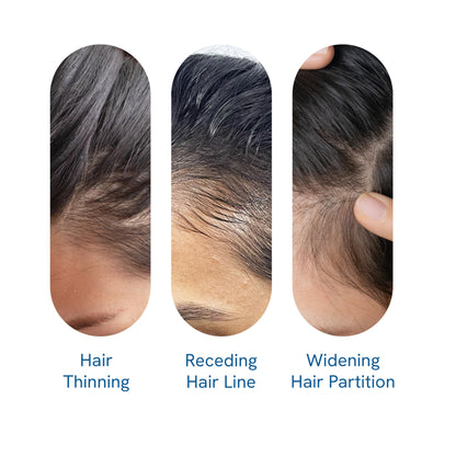 Be Bodywise Rosemary Hair Growth Serum Roll On 25 ml – 3% Rosemary, 3% Redensyl & 2% Anagain | DHT-Blocking Scalp Serum Boosts Oxygen Flow, Reduces Hair Fall | Paraben/Sulfate-Free | Women & Men
